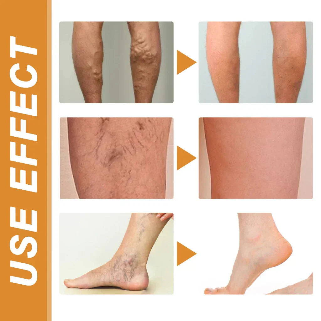 Varicose Veins Spray – Natural Herbal Formula for Fast Relief