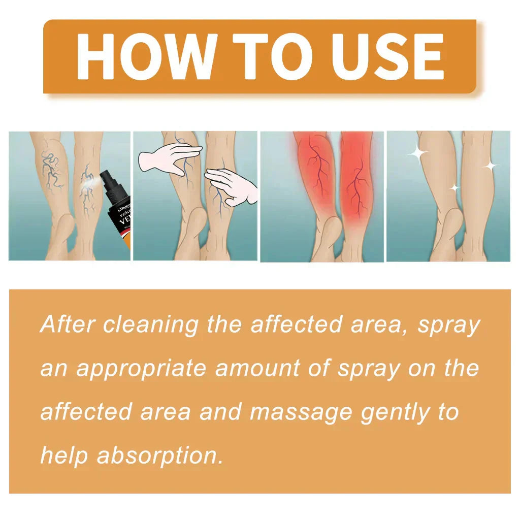 Varicose Veins Spray – Natural Herbal Formula for Fast Relief